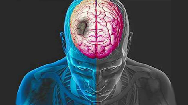 Toscana: La lotta all’ictus passa attraverso la&nbsp;ricerca