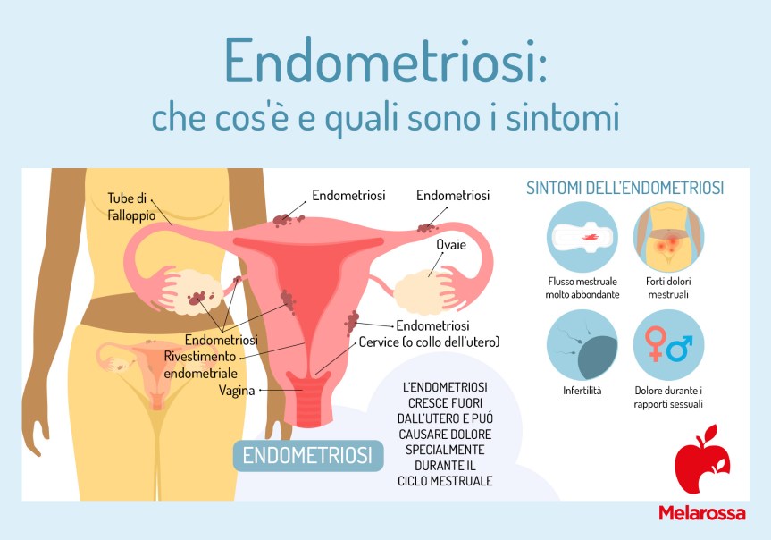 Siena: Endometriosi, è senese il test genetico rivoluzionario predittivo della&nbsp;malattia